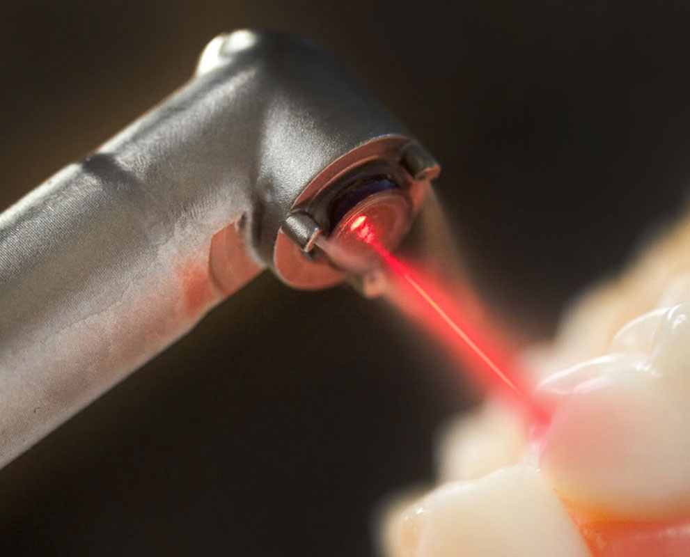 Dental Code For Laser Therapy at Shelly Christman blog