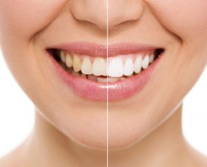 photo shows before and after Teeth Whitening in KL at Tiew Dental's