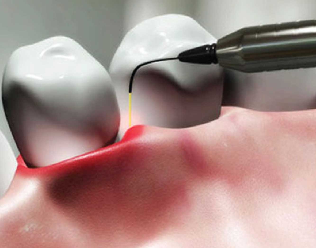 Абразивный метод. Лазерное препарирование кариеса. Эрбиевый лазер в стоматологии.