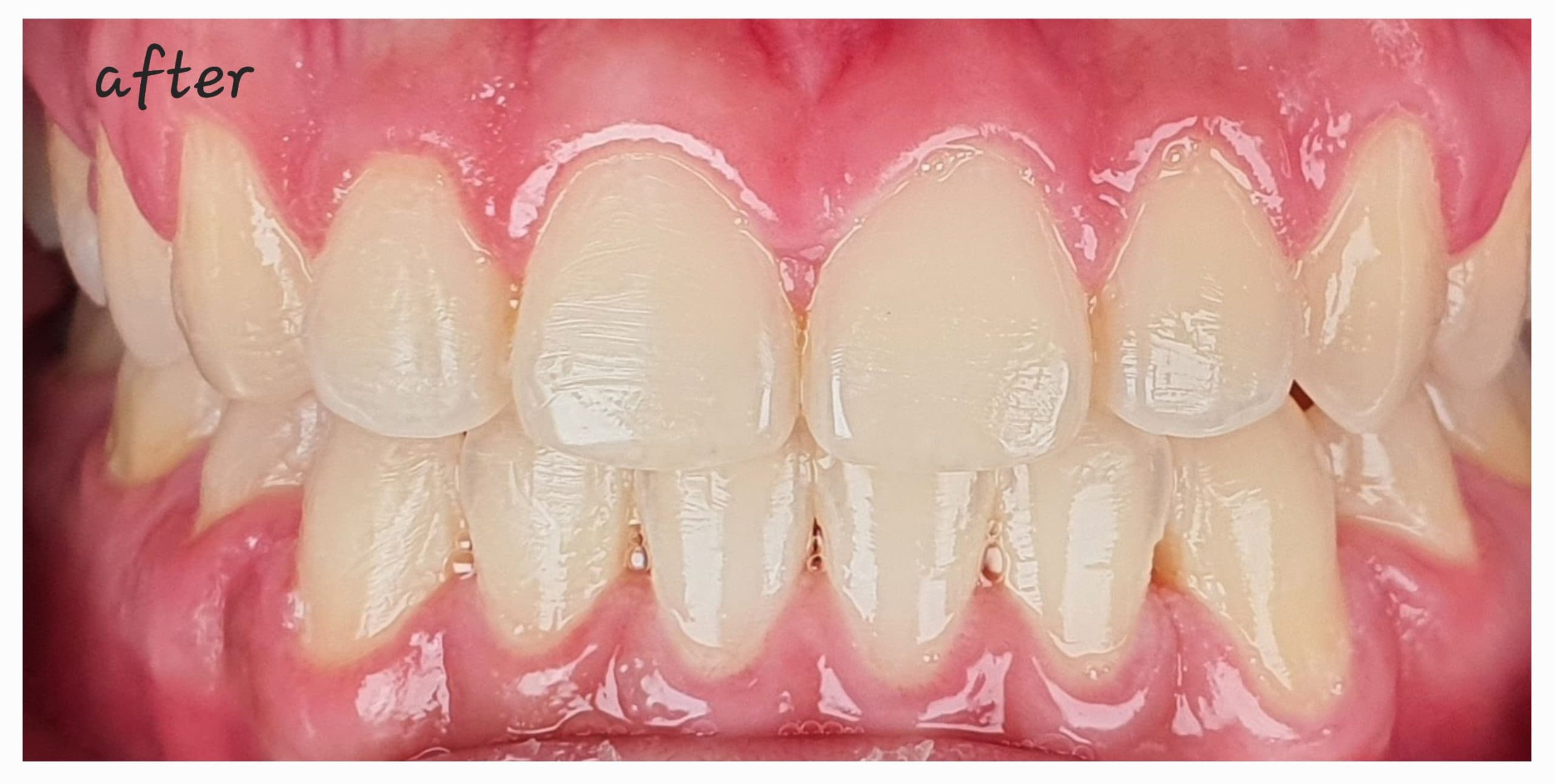 Before-and-After-Open-bite 1