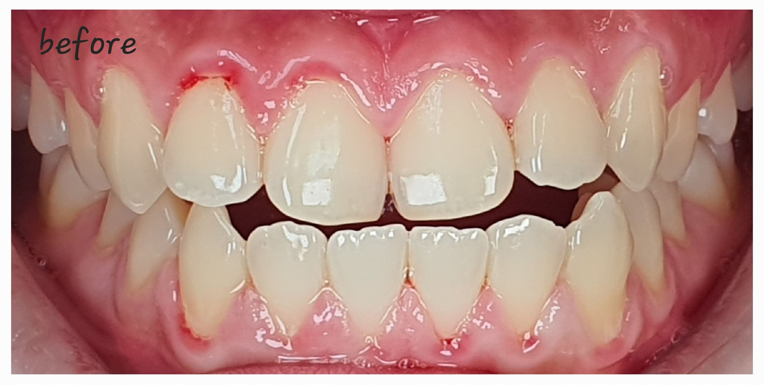 Before-and-After-Open-bite 2