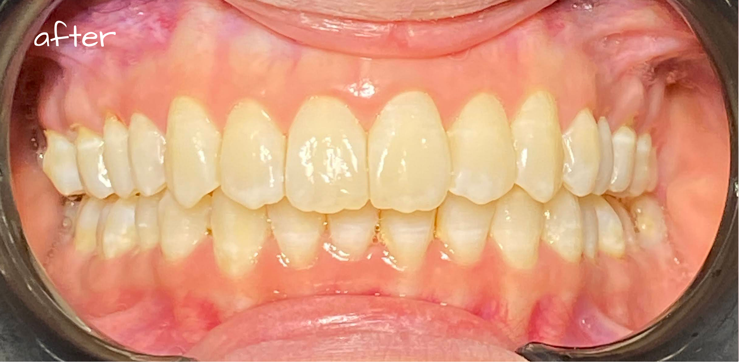 anterior_combine 1 (1)