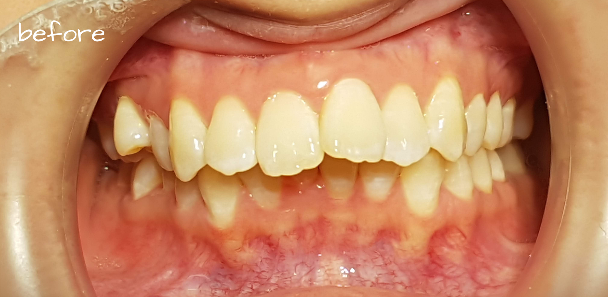 anterior_combine 2 (2)