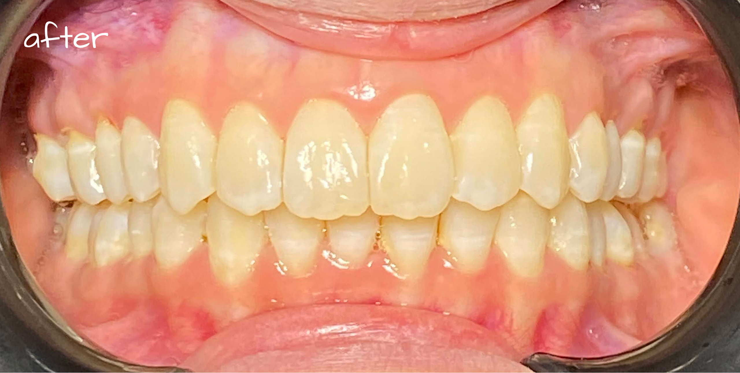 invisalign after 01