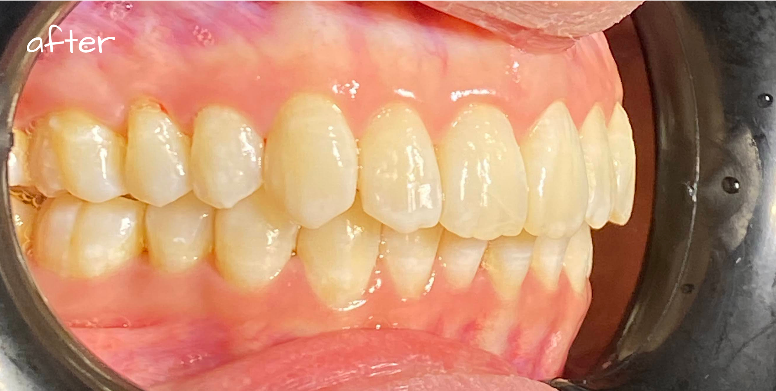 invisalign after 03