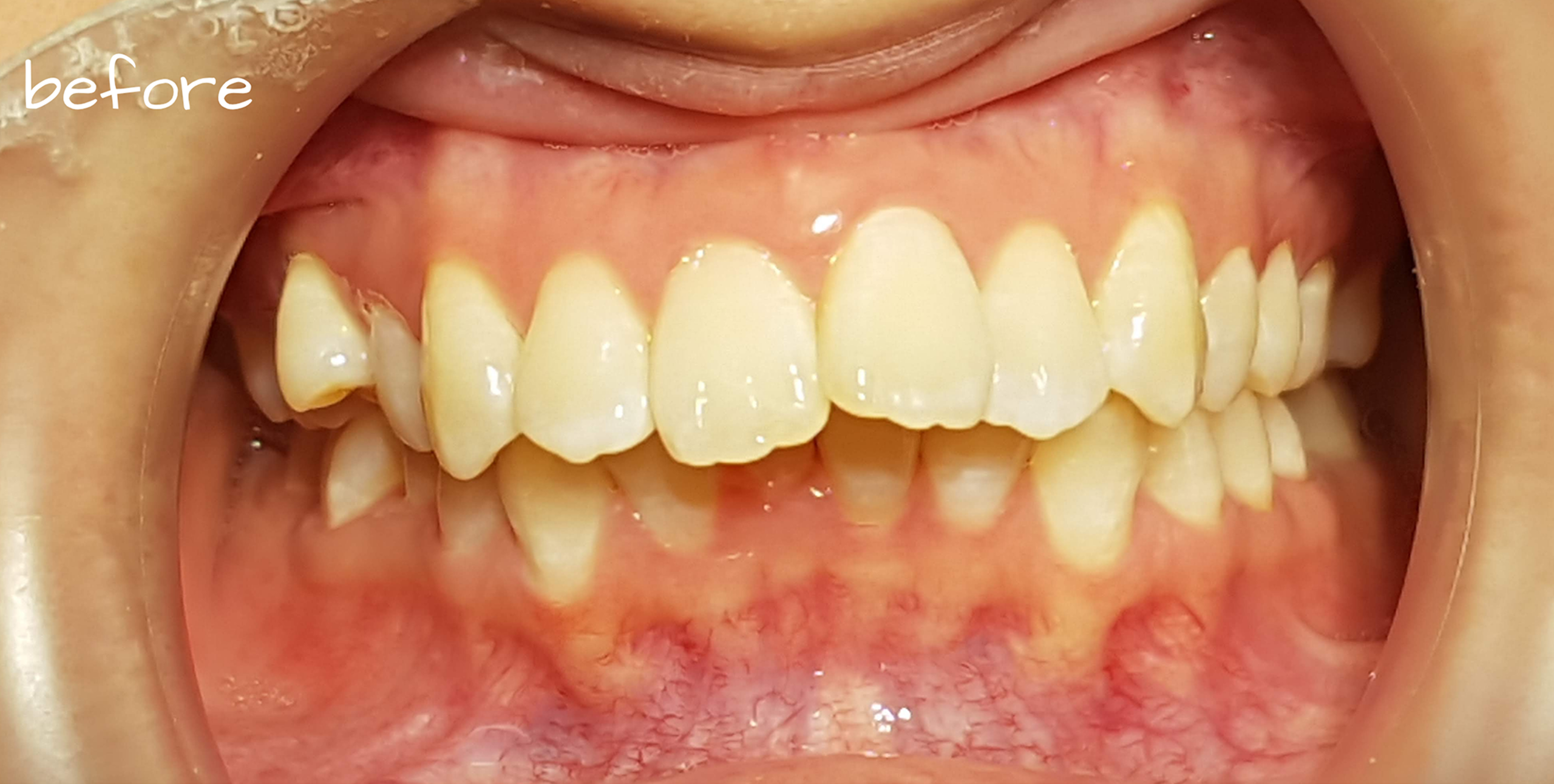 invisalign before 01