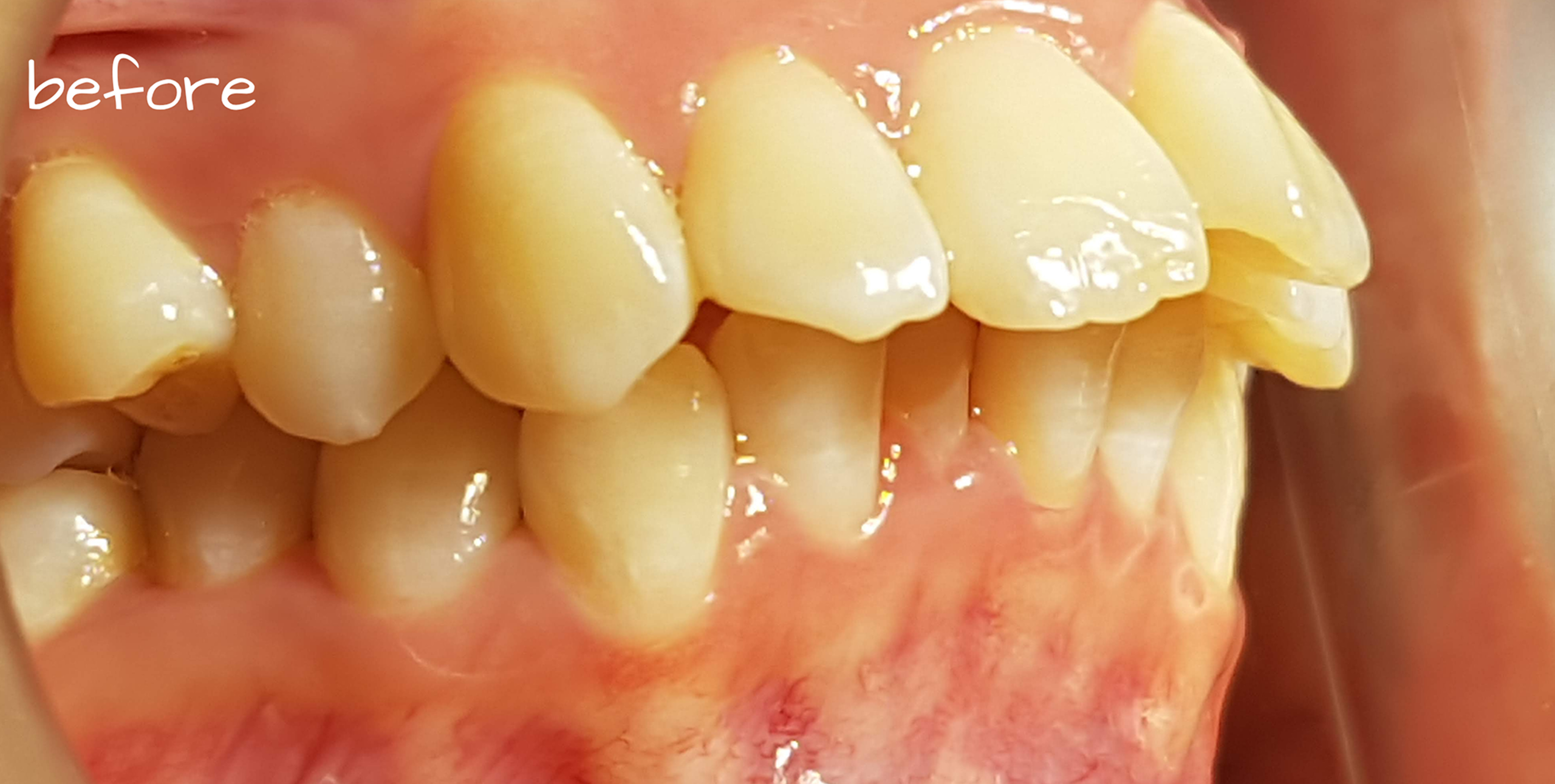 invisalign before 02